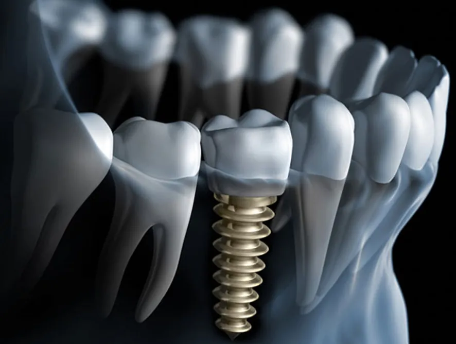 Implant